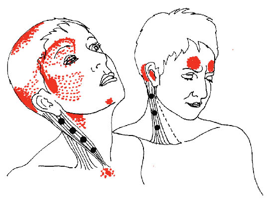 Trigger Points Map
